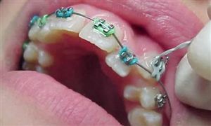 網(wǎng)購(gòu)牙齒矯正器 真的靠譜嗎 口腔正畸行業(yè)市場(chǎng)深度分析及發(fā)展策略研究報(bào)告
